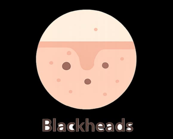 Blackheads